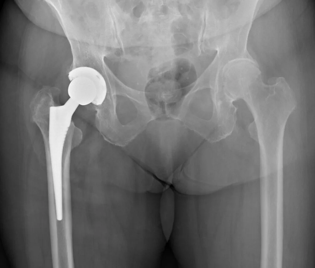 Et røntgenbillede af en hofteprotese