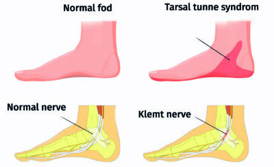 Figur med 4 fødder to af fødderne er normale, og de to andre lider af henholdsvis en klemt nerve og tarsal tunnel syndrom