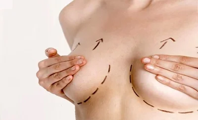 Kvinde med optegning på brysterne før brystløftoperation