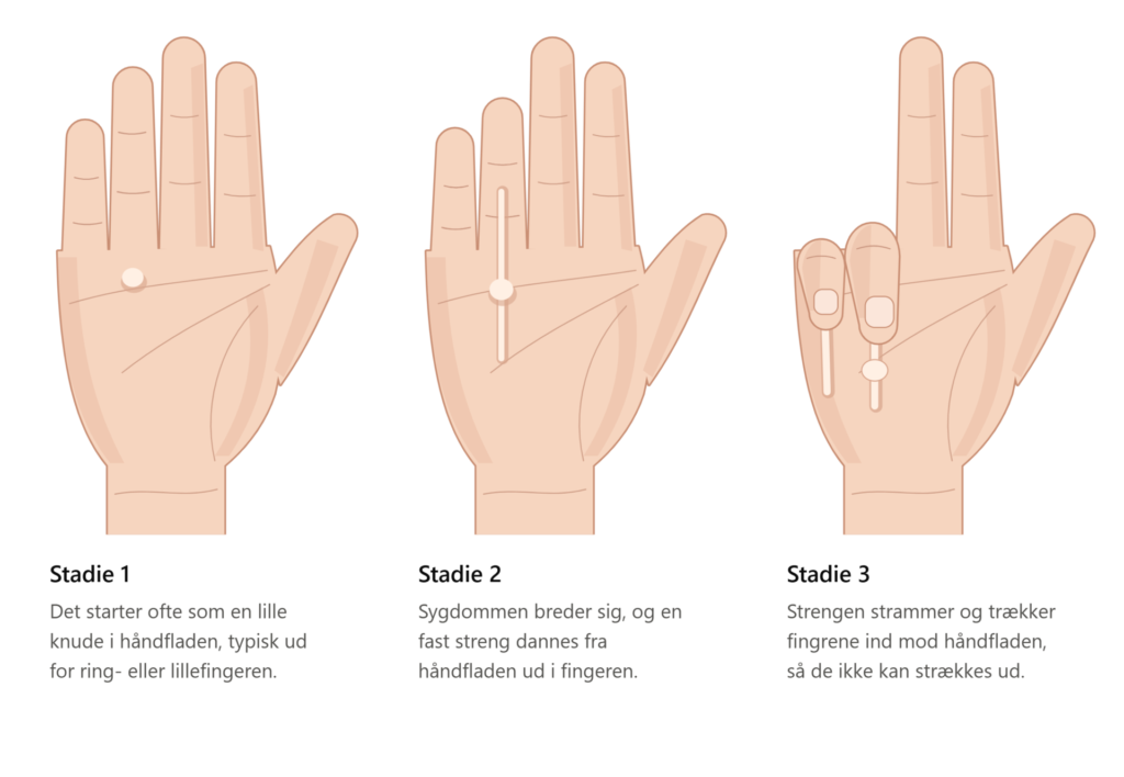 Illustration af Kuskefingre (Dupuytrens kontraktur)