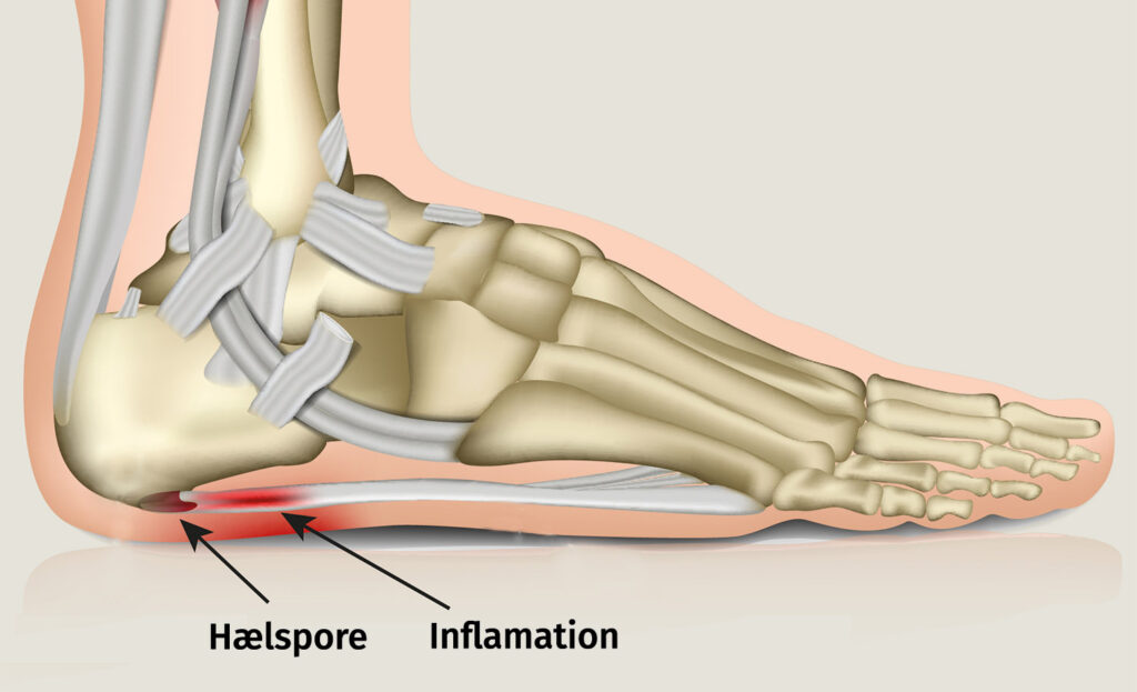 En figur af en fod hvor at man kan se fodens knogler, og hvor hælspore og inflammation sidder i hælen