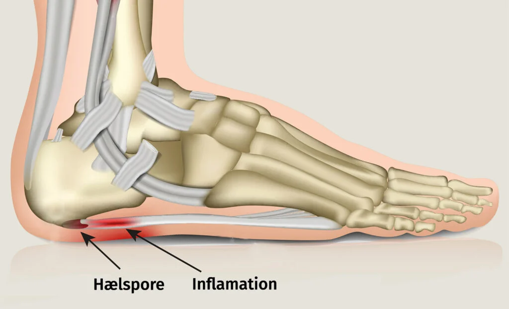 En figur af en fod hvor at man kan se fodens knogler, og hvor hælspore og inflammation sidder i hælen