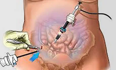Figur over hvordan man får foretaget en laparoskopi