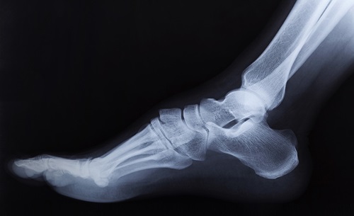 Et røntgenfoto af en hammertå