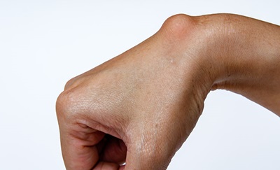 Et billede af en hånd hvor en seneknude buler ud.