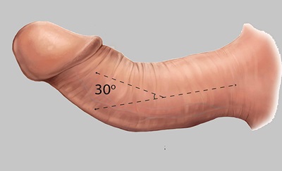 En figur af en skæv penis