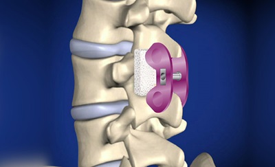 Figur af en spinalstenose efter operation