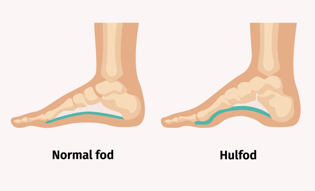 Figur af en normal fod og en hulfod