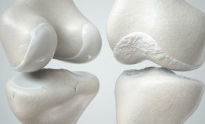 Slidgigt / figur af knogler med og uden slidgigt
