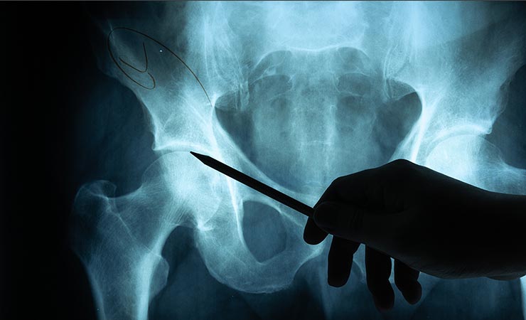 Røntgen af hofte med en pegende lægehånd med en kuglepen