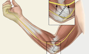 Figur af en indeklemt nerve i albuen.