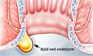 Figur af en byld/fistel ved endetarmen