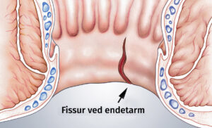 Figur af analfissur altså en revne ved endetarmsåbningen