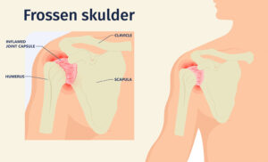 En figur af en frossen skulder