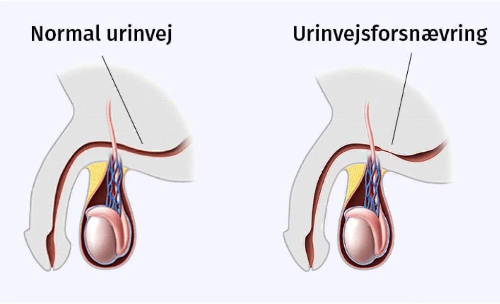 Figur af normal urinvej og en med urinrørsforsnævring